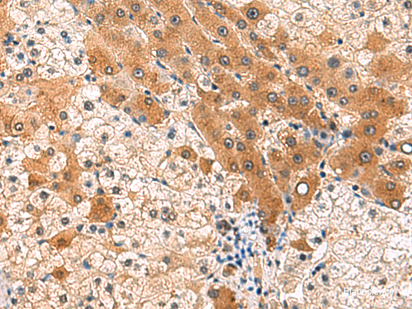 Immunohistochemistry of paraffin-embedded Human liver cancer tissue  using PCYT2 Polyclonal Antibody at dilution of 1:85(×200)
