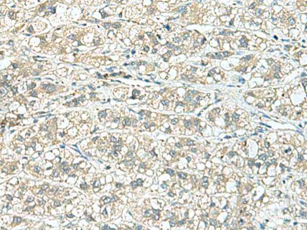 Immunohistochemistry of paraffin-embedded Human liver cancer tissue  using TENT5C Polyclonal Antibody at dilution of 1:110(×200)
