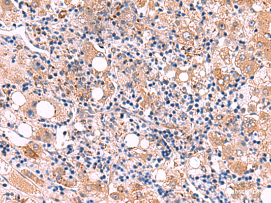 Immunohistochemistry of paraffin-embedded Human liver cancer tissue  using LIPA Polyclonal Antibody at dilution of 1:50(×200)
