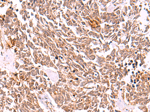 Immunohistochemistry of paraffin-embedded Human lung cancer tissue  using COPS3 Polyclonal Antibody at dilution of 1:50(×200)