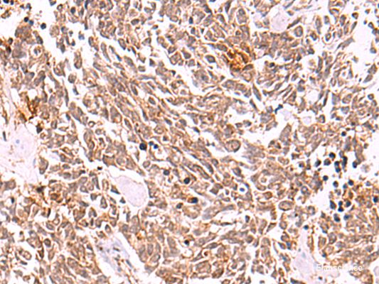 Immunohistochemistry of paraffin-embedded Human lung cancer tissue  using COPS3 Polyclonal Antibody at dilution of 1:50(×200)