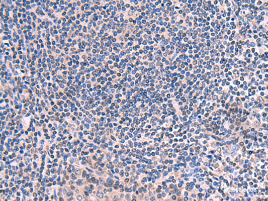 Immunohistochemistry of paraffin-embedded Human tonsil tissue  using SCCPDH Polyclonal Antibody at dilution of 1:50(×200)