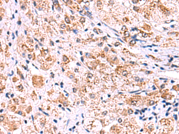 Immunohistochemistry of paraffin-embedded Human liver cancer tissue  using ECSIT Polyclonal Antibody at dilution of 1:75(×200)