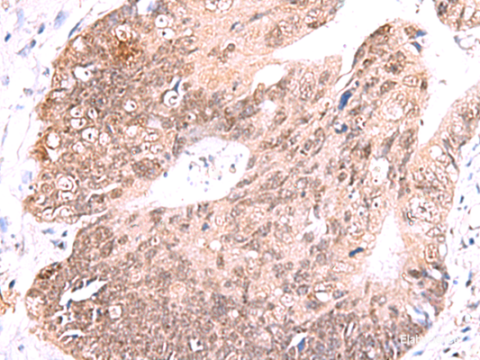 Immunohistochemistry of paraffin-embedded Human colorectal cancer tissue  using RUSC1 Polyclonal Antibody at dilution of 1:65(×200)