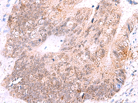 Immunohistochemistry of paraffin-embedded Human colorectal cancer tissue  using ASTN2 Polyclonal Antibody at dilution of 1:55(×200)