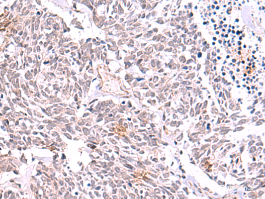 Immunohistochemistry of paraffin-embedded Human lung cancer tissue  using TRMT12 Polyclonal Antibody at dilution of 1:85(×200)