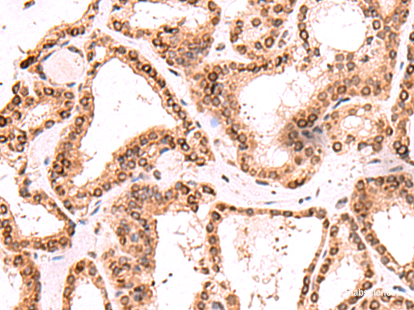 Immunohistochemistry of paraffin-embedded Human thyroid cancer tissue  using TOR1AIP1 Polyclonal Antibody at dilution of 1:60(×200)