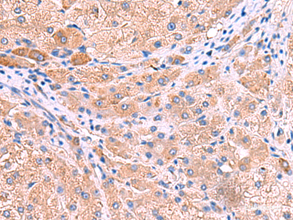 Immunohistochemistry of paraffin-embedded Human liver cancer tissue  using MPP1 Polyclonal Antibody at dilution of 1:50(×200)