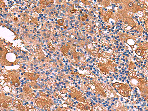 Immunohistochemistry of paraffin-embedded Human liver cancer tissue  using FUCA2 Polyclonal Antibody at dilution of 1:80(×200)