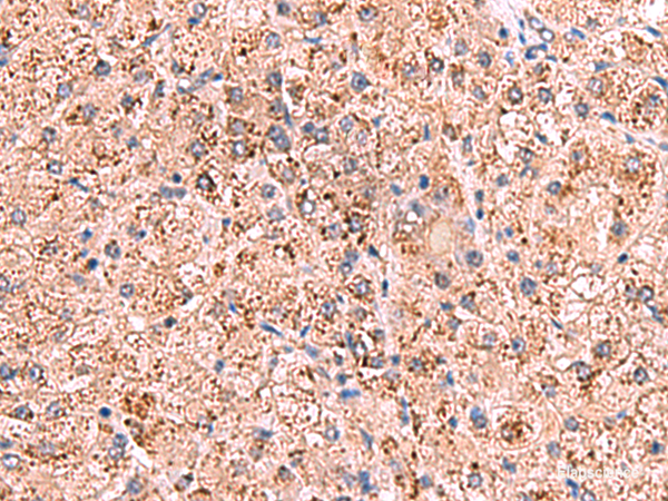 Immunohistochemistry of paraffin-embedded Human liver cancer tissue  using OSBPL2 Polyclonal Antibody at dilution of 1:65(×200)