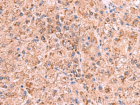 Immunohistochemistry of paraffin-embedded Human liver cancer tissue  using OSBPL2 Polyclonal Antibody at dilution of 1:65(×200)