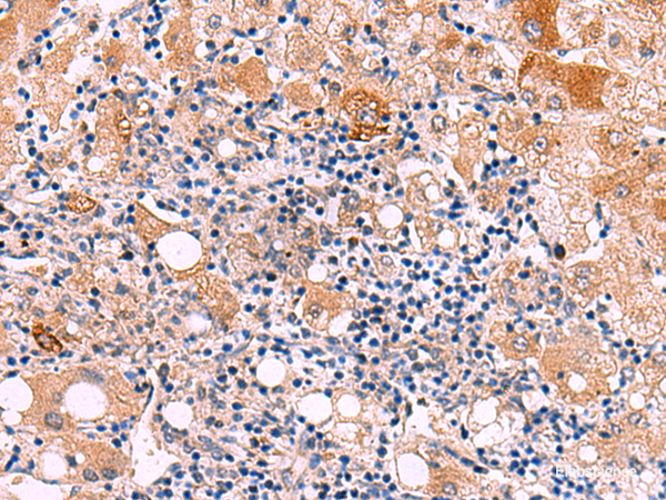 Immunohistochemistry of paraffin-embedded Human liver cancer tissue  using KATNAL1 Polyclonal Antibody at dilution of 1:80(×200)