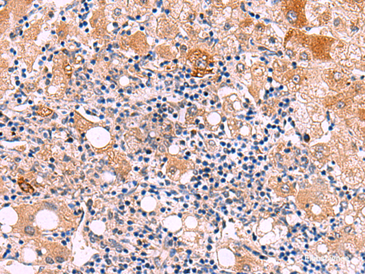 Immunohistochemistry of paraffin-embedded Human liver cancer tissue  using KATNAL1 Polyclonal Antibody at dilution of 1:80(×200)