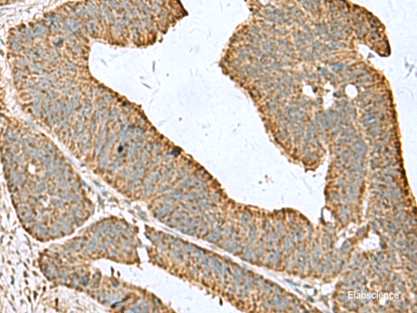 Immunohistochemistry of paraffin-embedded Human colorectal cancer tissue  using CDC20 Polyclonal Antibody at dilution of 1:50(×200)