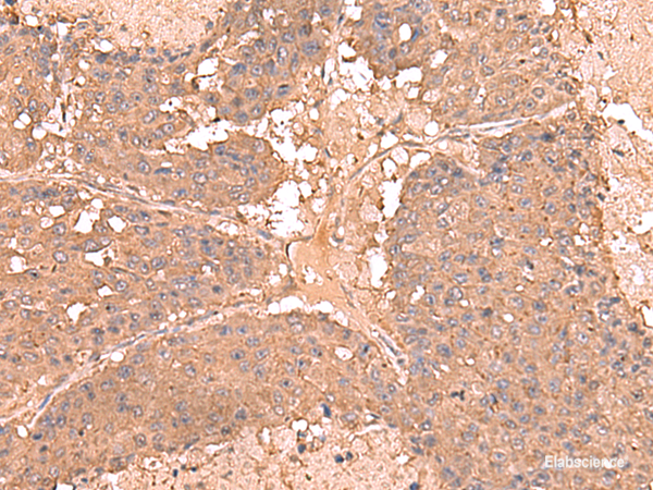 Immunohistochemistry of paraffin-embedded Human liver cancer tissue  using AHCYL1 Polyclonal Antibody at dilution of 1:65(×200)