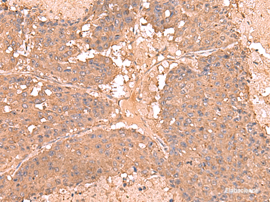Immunohistochemistry of paraffin-embedded Human liver cancer tissue  using AHCYL1 Polyclonal Antibody at dilution of 1:65(×200)