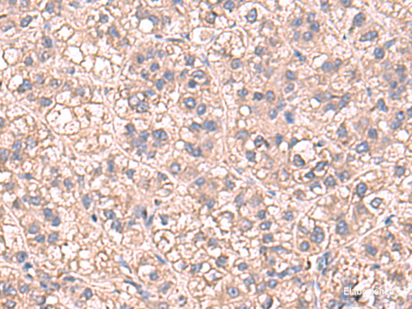 Immunohistochemistry of paraffin-embedded Human liver cancer tissue  using SARS Polyclonal Antibody at dilution of 1:60(×200)
