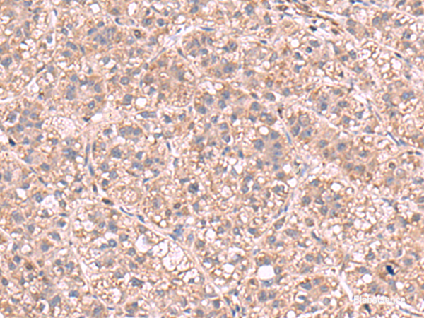 Immunohistochemistry of paraffin-embedded Human liver cancer tissue  using KPNA2 Polyclonal Antibody at dilution of 1:60(×200)