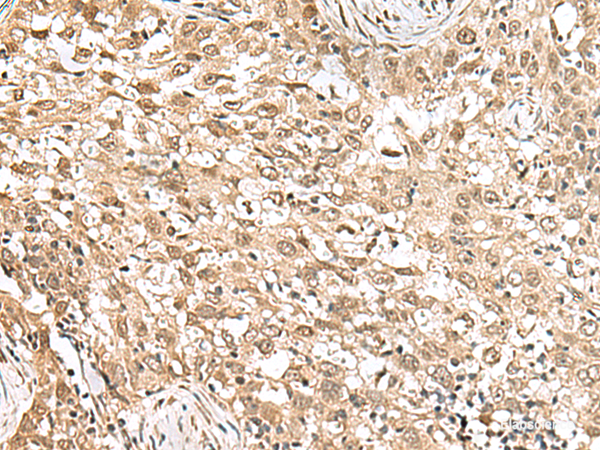 Immunohistochemistry of paraffin-embedded Human esophagus cancer tissue  using RPS6KA5 Polyclonal Antibody at dilution of 1:160(×200)