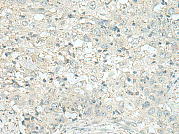 Immunohistochemistry of paraffin-embedded Human esophagus cancer tissue  using DENND6A Polyclonal Antibody at dilution of 1:120(×200)
