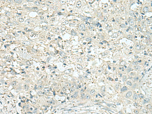 Immunohistochemistry of paraffin-embedded Human esophagus cancer tissue  using DENND6A Polyclonal Antibody at dilution of 1:120(×200)