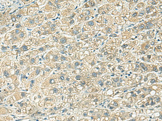 Immunohistochemistry of paraffin-embedded Human liver cancer tissue  using KLC2 Polyclonal Antibody at dilution of 1:100(×200)