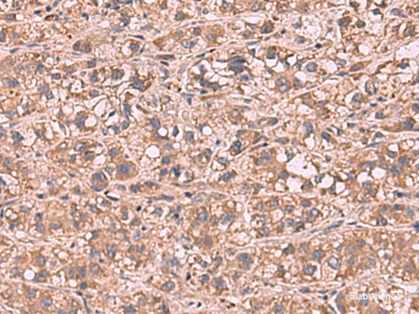 Immunohistochemistry of paraffin-embedded Human liver cancer tissue  using SHC4 Polyclonal Antibody at dilution of 1:90(×200)