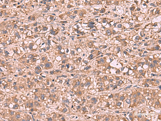 Immunohistochemistry of paraffin-embedded Human liver cancer tissue  using SHC4 Polyclonal Antibody at dilution of 1:90(×200)