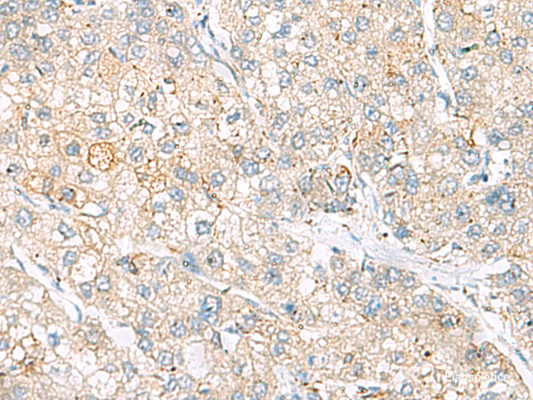 Immunohistochemistry of paraffin-embedded Human liver cancer tissue  using FARP2 Polyclonal Antibody at dilution of 1:55(×200)