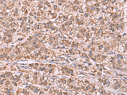 Immunohistochemistry of paraffin-embedded Human liver cancer tissue  using GUSB Polyclonal Antibody at dilution of 1:75(×200)