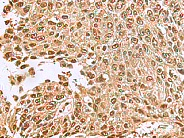 Immunohistochemistry of paraffin-embedded Human lung cancer tissue  using NVL Polyclonal Antibody at dilution of 1:70(×200)