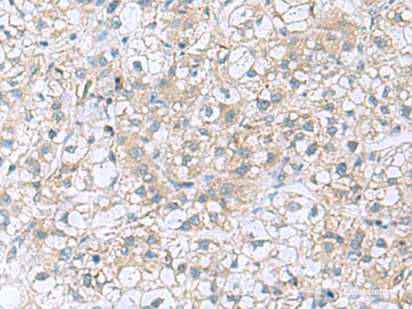 Immunohistochemistry of paraffin-embedded Human liver cancer tissue  using TRO Polyclonal Antibody at dilution of 1:80(×200)