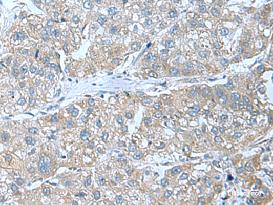 Immunohistochemistry of paraffin-embedded Human liver cancer tissue  using SRPK2 Polyclonal Antibody at dilution of 1:55(×200)