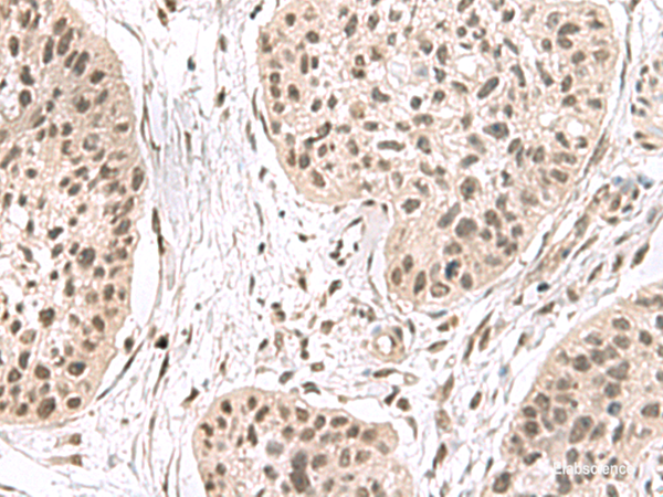 Immunohistochemistry of paraffin-embedded Human esophagus cancer tissue  using ERH Polyclonal Antibody at dilution of 1:55(×200)