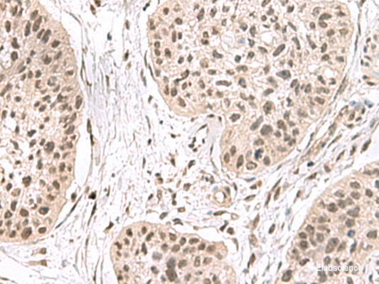 Immunohistochemistry of paraffin-embedded Human esophagus cancer tissue  using ERH Polyclonal Antibody at dilution of 1:55(×200)