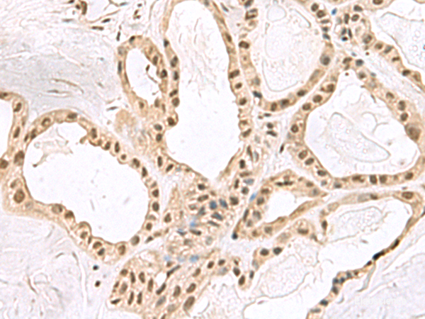 Immunohistochemistry of paraffin-embedded Human thyroid cancer tissue  using PCLAF Polyclonal Antibody at dilution of 1:60(×200)