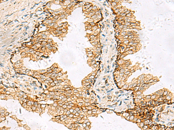 Immunohistochemistry of paraffin-embedded Human prost at e cancer tissue  using SH3YL1 Polyclonal Antibody at dilution of 1:55(×200)