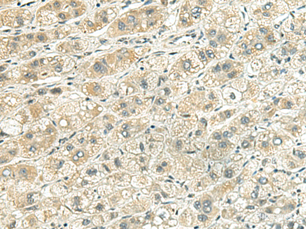 Immunohistochemistry of paraffin-embedded Human liver cancer tissue  using RHBDL2 Polyclonal Antibody at dilution of 1:140(×200)