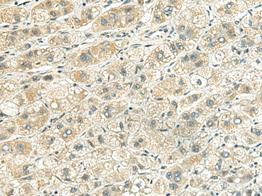 Immunohistochemistry of paraffin-embedded Human liver cancer tissue  using RHBDL2 Polyclonal Antibody at dilution of 1:140(×200)