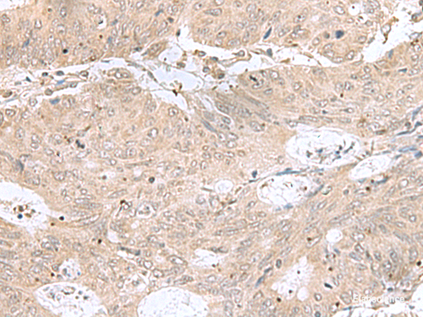 Immunohistochemistry of paraffin-embedded Human colorectal cancer tissue  using RPL35 Polyclonal Antibody at dilution of 1:50(×200)