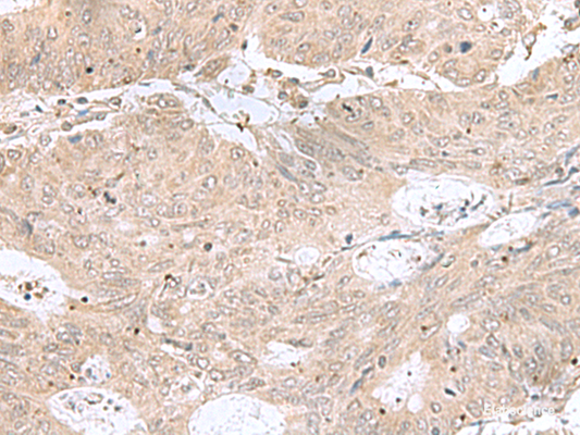 Immunohistochemistry of paraffin-embedded Human colorectal cancer tissue  using RPL35 Polyclonal Antibody at dilution of 1:50(×200)
