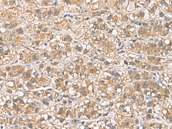 Immunohistochemistry of paraffin-embedded Human liver cancer tissue  using PHLDA3 Polyclonal Antibody at dilution of 1:110(×200)