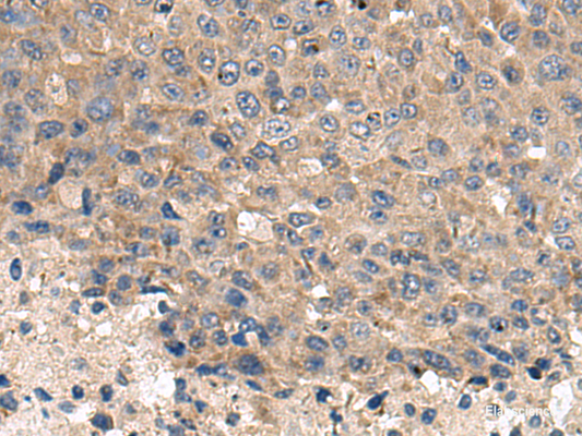 Immunohistochemistry of paraffin-embedded Human liver cancer tissue  using CD59 Polyclonal Antibody at dilution of 1:120(×200)