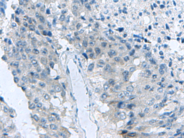 Immunohistochemistry of paraffin-embedded Human liver cancer tissue  using MED31 Polyclonal Antibody at dilution of 1:140(×200)