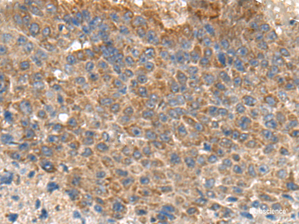 Immunohistochemistry of paraffin-embedded Human liver cancer tissue  using MIA Polyclonal Antibody at dilution of 1:180(×200)