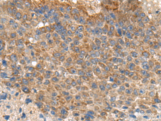 Immunohistochemistry of paraffin-embedded Human liver cancer tissue  using MIA Polyclonal Antibody at dilution of 1:180(×200)