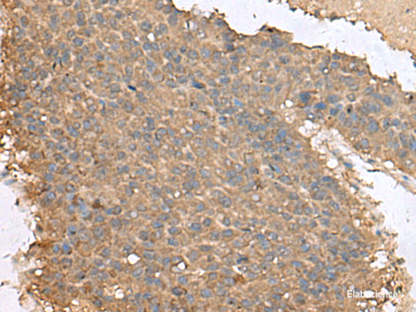 Immunohistochemistry of paraffin-embedded Human liver cancer tissue  using FAM19A4 Polyclonal Antibody at dilution of 1:65(×200)