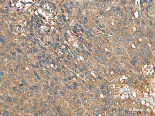 Immunohistochemistry of paraffin-embedded Human liver cancer tissue  using EIF1AX Polyclonal Antibody at dilution of 1:105(×200)