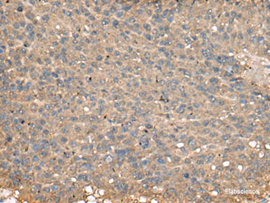 Immunohistochemistry of paraffin-embedded Human liver cancer tissue  using PLA2G2A Polyclonal Antibody at dilution of 1:55(×200)