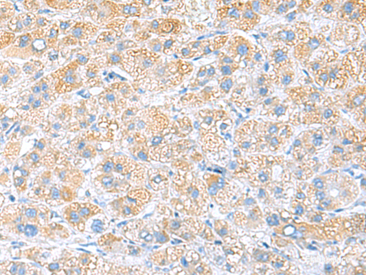 Immunohistochemistry of paraffin-embedded Human liver cancer tissue  using RPS16 Polyclonal Antibody at dilution of 1:65(×200)